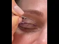Upper Blepharoplasty Markings
