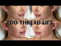 PDO Thread Lift Experience