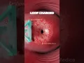 Download Lagu Verwijdering van abnormaal baarmoederhalsweefsel (3D-animatie)
