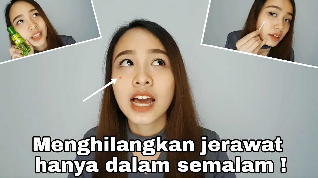 
          
          
          
            
            Cara Menghilangkan Jerawat Dalam Satu Malam ! + Ngobrol Soal Jerawat | Savira Millenita
          
        . 