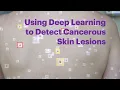 Using deep learning to detect cancerous skin lesions FINAL