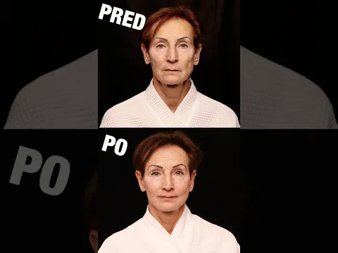 Video Thumbnail: Zobral som mamu na plastickú operáciu (PRED A PO)