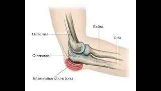 Excision of Bursa CPT code - simplify medical coding