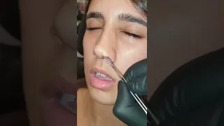 إزالة فتايل في فرعنا اسطنبول للحجز 00989386985112 تجميل الانف تجميل الأنف قطريات عمان كويت 