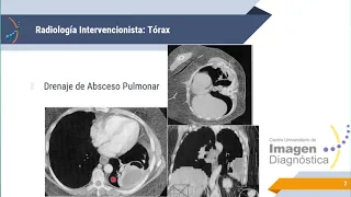 Radiología Intervencionista