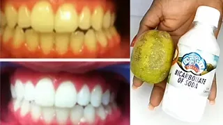 how to remove  dental plaque from teeth whitening teeth at home