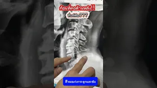 ทำไมเวลาเอนคอลงแล้วดูเหมือนมีก้อนนูนที่คอ