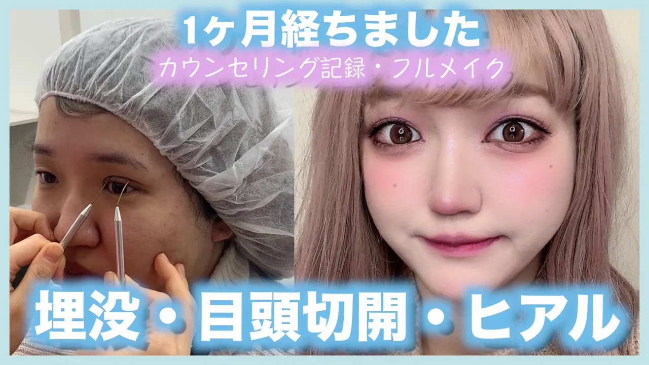 【二重整形】術後1ヶ月♡カウンセリングVLOGとフルメイク【アップデート】