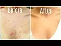 How I Got Rid Of My Body Acne FOREVER