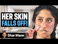 Download Lagu Girl Whose SKIN FALLS OFF! | Dhar Mann Studios
