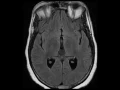 Pineal Gland Cyst