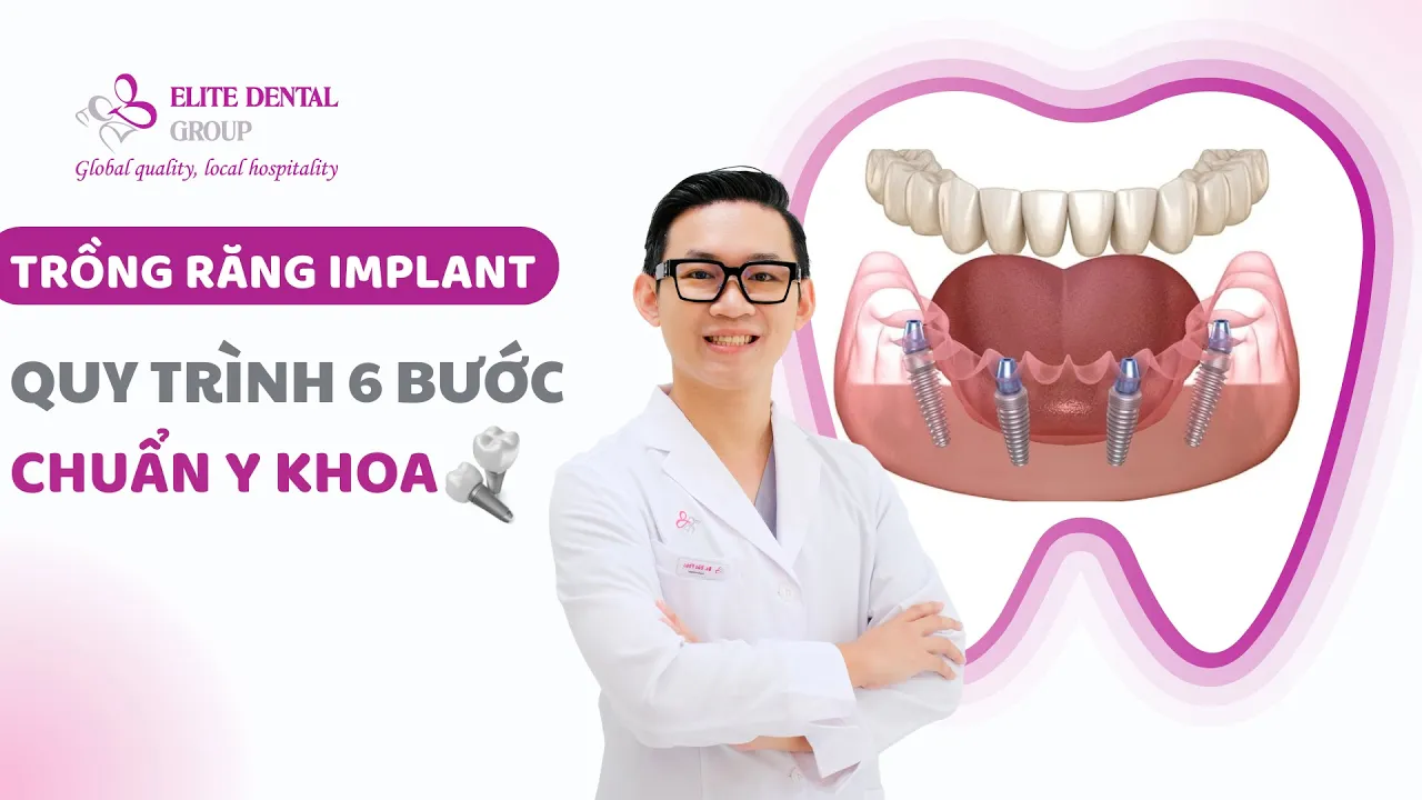 Outline Video Quy trình trồng răng Implant 6 bước tại nha khoa Elite