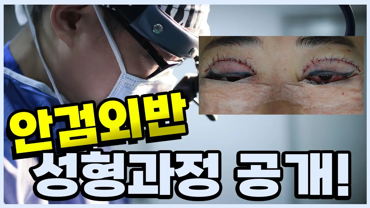 안검외반 수술방법 전격공개! 어떤식으로 수술해야 안전한걸까요? │ 라리성형외과