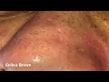 Blackheads Extractions and Acne Treatment on Daryl