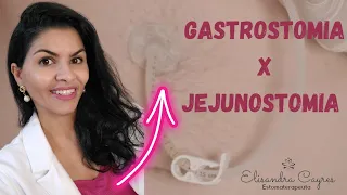 GASTROSTOMIA E JEJUNOSTOMIA VOCÊ SABE QUAL É A DIFERENÇA?
