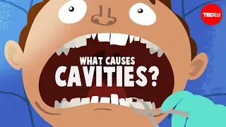 What Causes Cavities Mel Rosenberg 