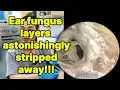 Download Lagu Ear fungus layers astonishingly stripped away | ear cleaning | ASMR earwax | soothing |relax|