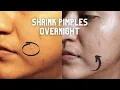 How to DRASTICALLY REDUCE YOUR PIMPLE SIZE OVER NIGHT Vitacilina Benzoyl Peroxide Pimple Patches