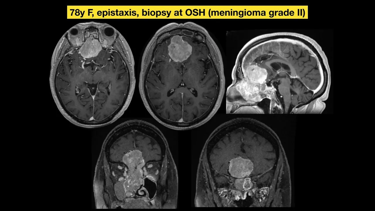 🧠Olfactory groove meningioma🧠