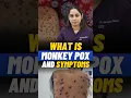 What Is Monkey POX Virus I Symptoms Precautions