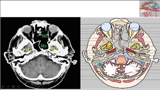 Neuroimagen - SECC