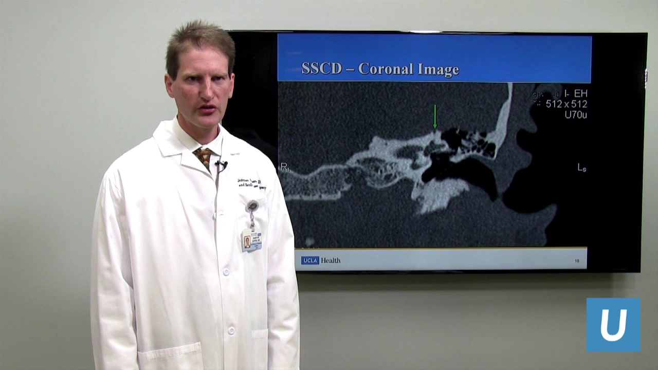 Superior Semicircular Canal Dehiscence | Quinton Gopen, MD | UCLAMDChat