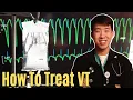 How To Treat VTach Ventricular Tachycardia - Easy