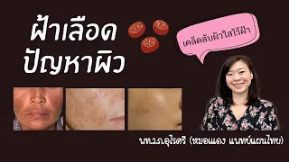  ทำไมผิวหน้าถึงมีปัญหาอย่างสิวหรือฝ้าเลือด แม้จะดูแลผิวอย่างดีแล้ว 