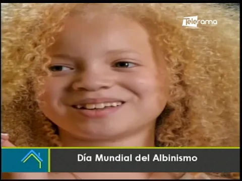Día mundial del Albinismo