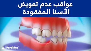عواقب عدم تعويض الأسنا المفقودة 