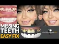 INSTANT Solution For Missing Teeth With Snap On Veneers