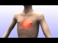 Wat is angina pectoris?