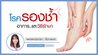  รองช้ำคืออะไร และเกิดจากสาเหตุอะไรบ้าง 