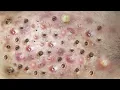 Loan Nguyen Acne Treatment 6p