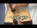 Tattoo Removal in Naples FL by ReversaTatt Tattoo Removal