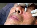 How to get rid of Seborrheic Keratosis at Ultimate Aesthetics Beauty Salon Subiaco