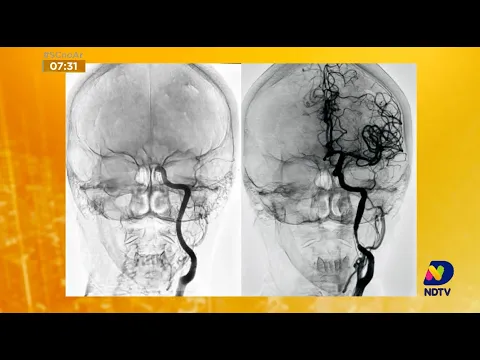 Hospital São José recebe novo aparelho para tratamentos neurológicos em Joinville