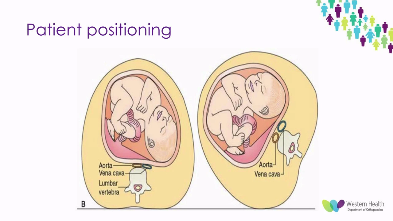 Orthopaedic Trauma in Pregnant Patients by Dr Adrian Talia