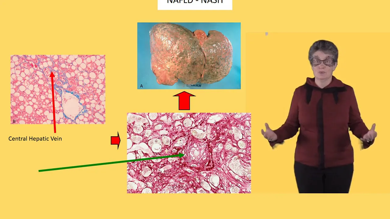 Liver pathology