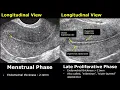 Endometrial Thickness Ultrasound Image Appearances Endometrium Menstrual Cycle USG Images