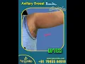 Download Lagu Axillary Breast tissue removal surgery @  Personiks Hyderabad | Dr.Gurukarna Vemula