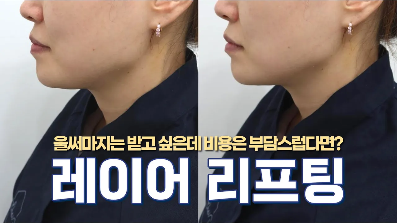 울써마지는 받고 싶은데 비용은 부담스럽다면?! ㅣ 레이어리프팅 ㅣ 슈링크 유니버스와 코레지의 조합!