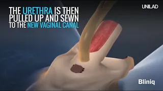 Sex Reassignment Surgery Male to Female at Bliniq Cosmetic Surgery Centre and Medspa