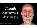 Sinusitis Animation