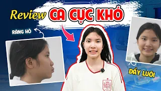 Niềng Răng Hô Cho Bé 12 Tuổi: Tật Đẩy Lưỡi Có Khiến Điều Trị Khó Hơn? Review Ca Thực Tế.