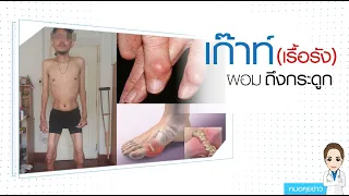 โรคเกาต์เกิดจากสาเหตุอะไร และมีอาการอย่างไรบ้าง