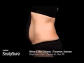 Dr Sean Simon Plastic Surgery Miami - SculpSure Before After Results