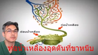 โรคบวมน้ำเหลืองเกิดจากสาเหตุอะไรบ้าง และมีความสัมพันธ์กับการรักษาโรคมะเร็งอย่างไร