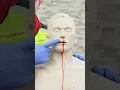 Download Lagu Eerste hulp bij neusbloedingen 🩸🤕 #ambulance #eerstehulp #paramedicus #ziekenhuis #spoedeisende hulp #verpleegkundige