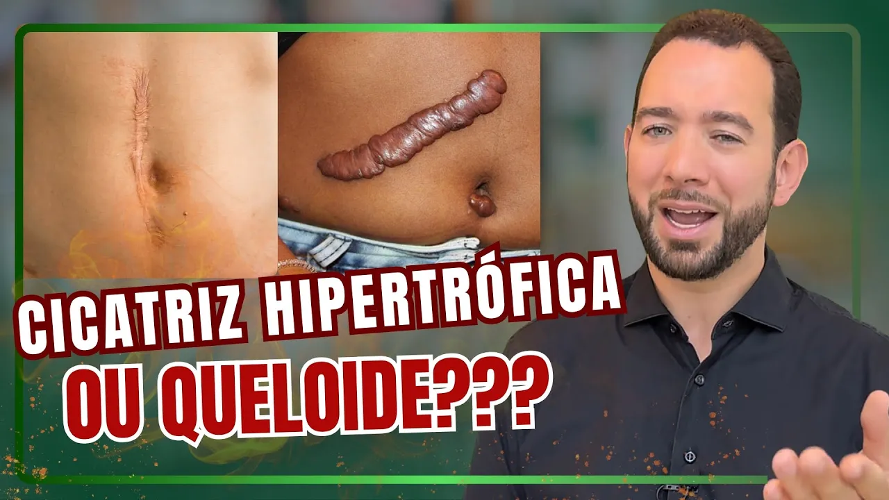 Queloide ou Cicatriz Hipertrófica? O que ninguém te conta sobre as cicatrizes que crescem demais! 👀
